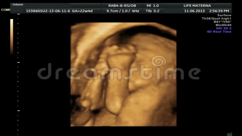 4胎儿在子宫内玩耍的D超声扫描视频的预览图