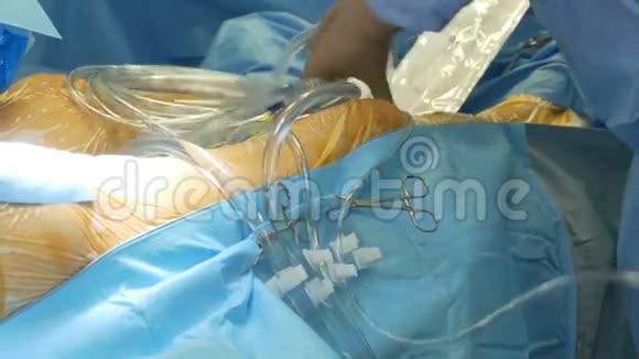 安排手术引流管视频的预览图