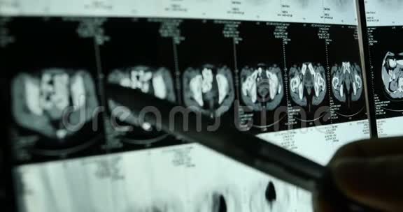 医生研究头骨脑X线片进行分析健康医疗医院视频的预览图