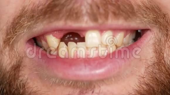嘴的特写一个男人展示他的假牙视频的预览图