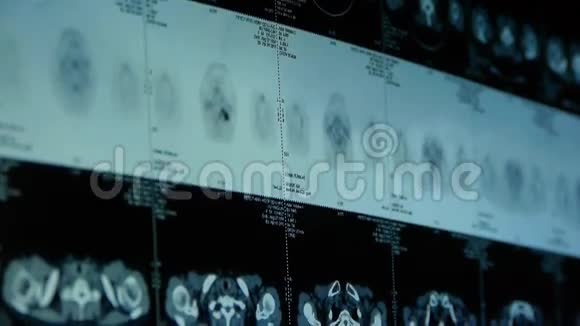 人锁骨下petct扫描淋巴结X线肿瘤转移视频的预览图