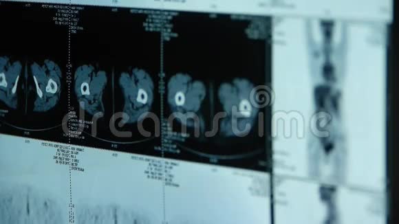人眼影骨PETct扫描X线肿瘤转移视频的预览图