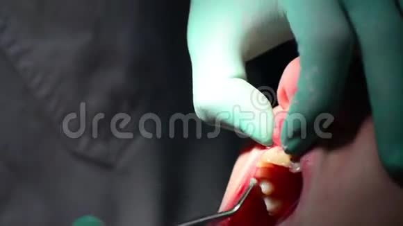 牙医检查牙龈炎的牙龈视频的预览图