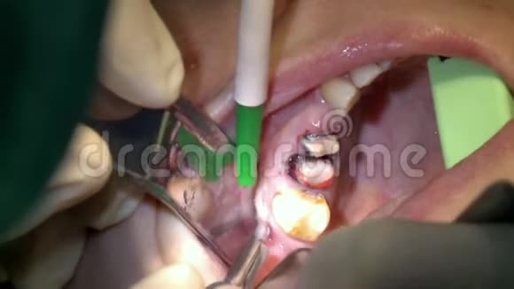 牙医用外科钳子去除蛀牙视频的预览图