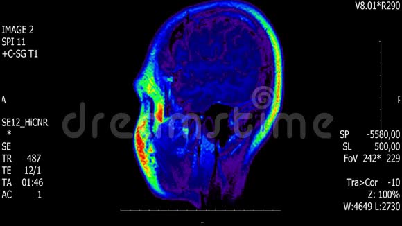 真实生命人脑核磁共振扫描与肿瘤医学研究新质量健康科学4k镜头股票动画视频的预览图