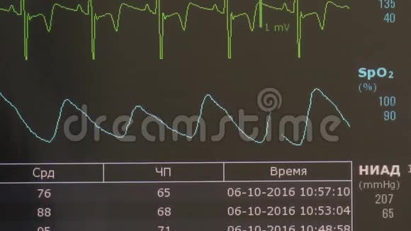 术中监护仪心律及脉搏图像的心电图视频的预览图