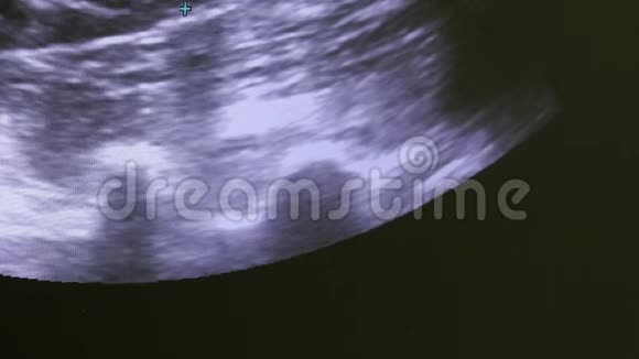 监测超声检查设备上的女性子宫图像视频的预览图