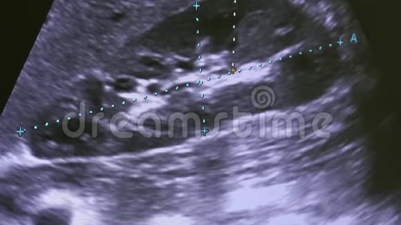 监测超声检查设备上的女性子宫图像视频的预览图