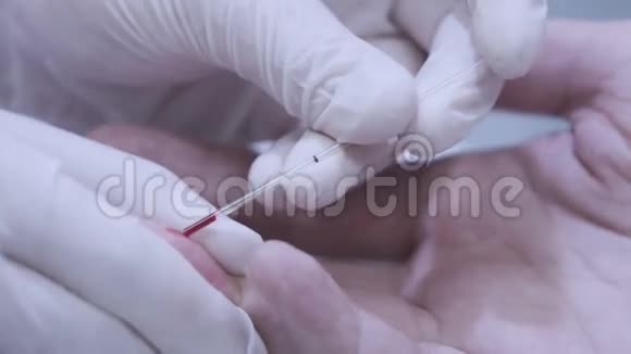 医生手拿血样进行医学检验手指血液测试视频的预览图