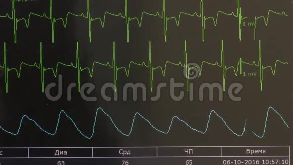 术中监护仪心律及脉搏图像的心电图视频的预览图