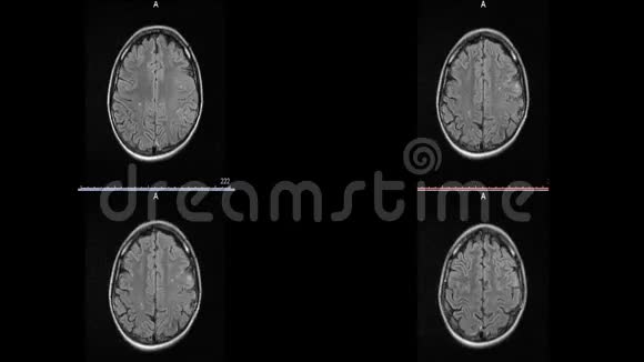 脑硬化微中风白斑的磁共振成像视频的预览图