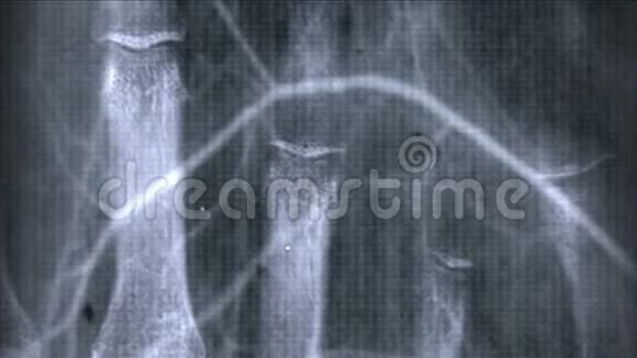 人体肋骨指骨扫描技术医学X线医学研究身体健康视频的预览图