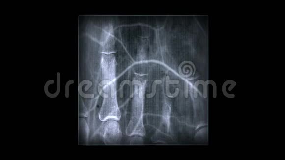 人体肋骨指骨扫描技术医学X线医学研究身体健康视频的预览图