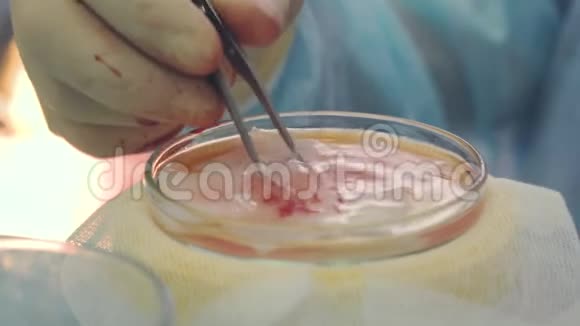 杯中毛囊特写秃头治疗头发移植手术室里的外科医生做头发视频的预览图