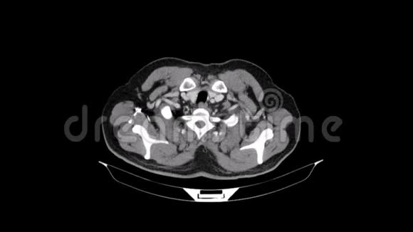 血管胸腔的门脉期视频的预览图