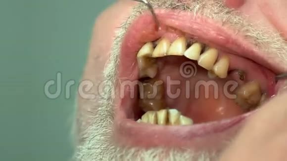 牙齿不好的病人视频的预览图