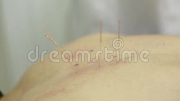 针刺针扎病人背部视频的预览图