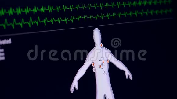 患者监护仪显示生命体征心电图心电图概念视频的预览图