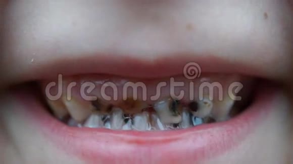 儿童牙齿上的足龋闭合视频的预览图