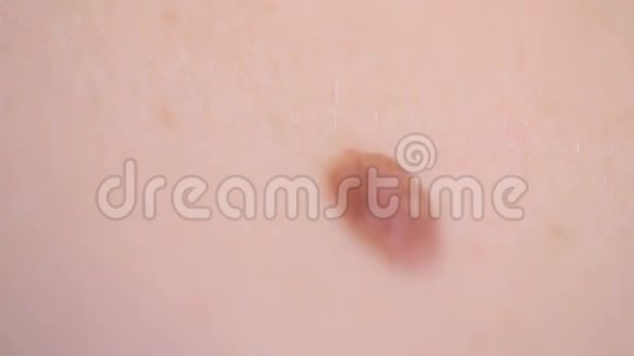 在人体皮肤上发现痣大胎记视频的预览图