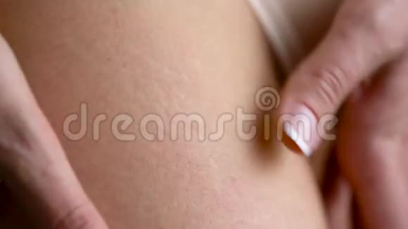 女性臀部皮肤上的拉伸痕迹视频的预览图