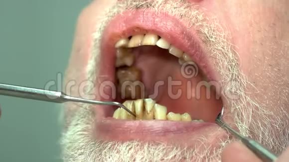 牙医的病人坏牙视频的预览图