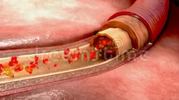 阿司匹林用于抗血小板治疗视频的预览图