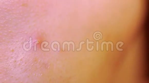 皮肤上的粉刺特写和润滑粉刺视频的预览图
