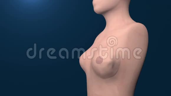 乳腺癌细胞生长动画视频的预览图
