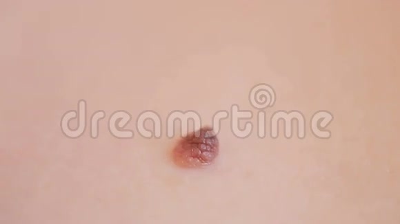 在人体皮肤上发现痣大胎记视频的预览图