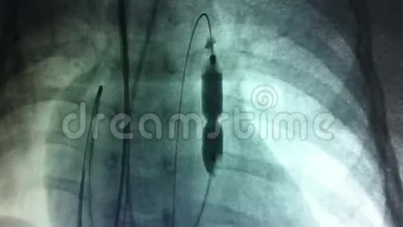 肺动脉瓣膜球囊扩张视频的预览图