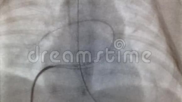 肺动脉瓣膜球囊扩张视频的预览图