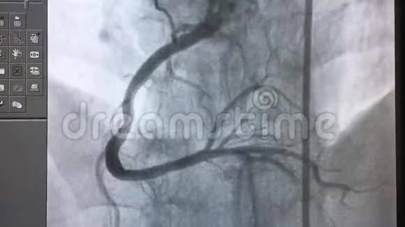 冠状动脉造影右冠状动脉造影视频的预览图