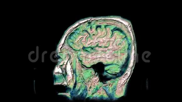大量的彩色MRI扫描大脑和头部以检测肿瘤诊断医疗工具视频的预览图