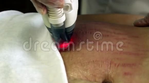 激光皮肤治疗视频的预览图