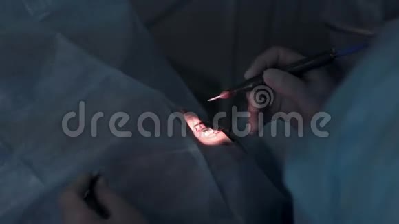 无法辨认医生手在医院手术室做手术视频的预览图