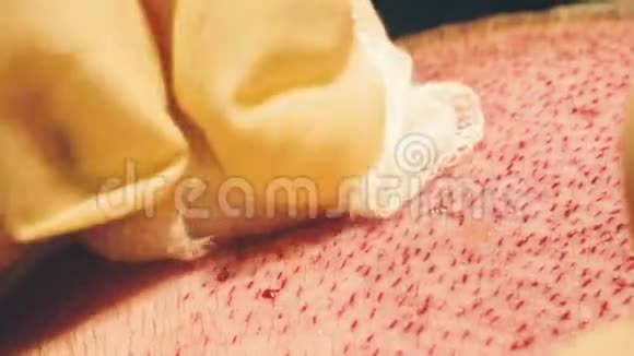 移植到无毛区的毛球的显微摄影秃头治疗头发移植外科医生视频的预览图