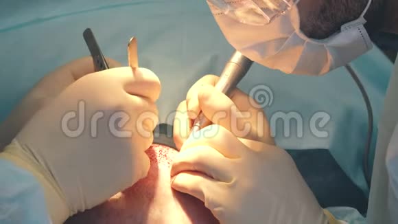 秃头治疗头发移植手术室的外科医生进行毛发移植手术外科手术视频的预览图