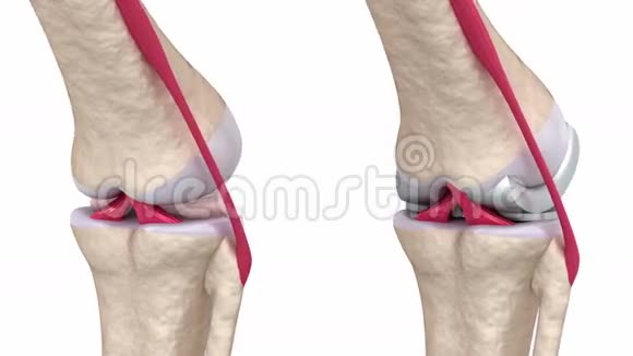 膝关节和钛铰关节视频的预览图