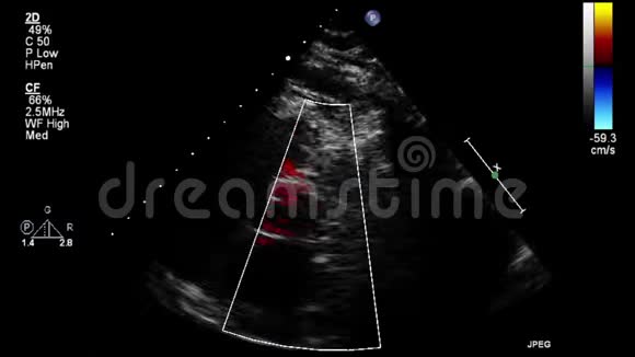 经食管超声检查心脏视频的预览图
