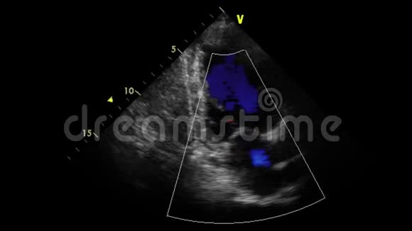 经食管超声检查心脏视频的预览图