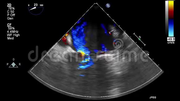 经食管超声检查心脏视频的预览图