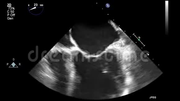 经食管超声检查心脏视频的预览图
