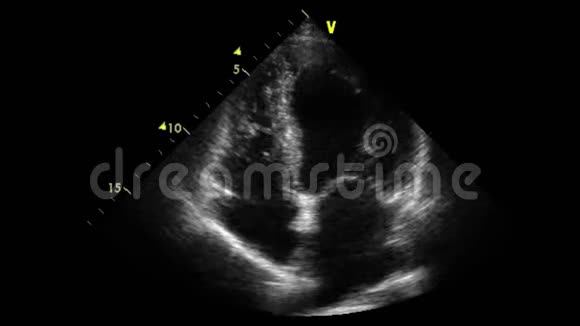 经食管超声检查心脏视频的预览图
