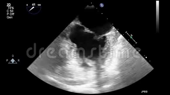 经食管超声检查心脏视频的预览图