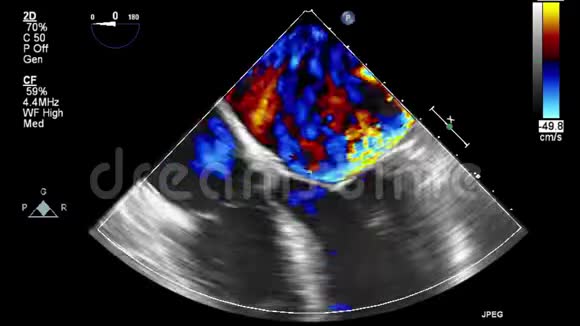 经食管超声检查心脏视频的预览图