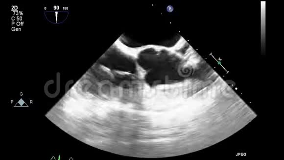 经食管超声检查心脏视频的预览图