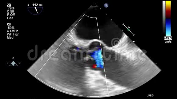 经食管超声检查心脏视频的预览图
