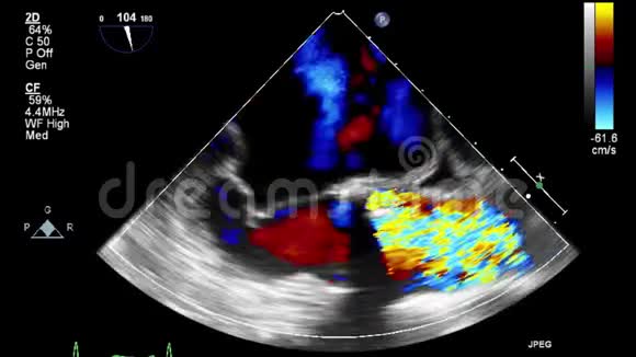 经食管超声检查心脏视频的预览图