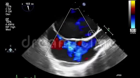 经食管超声检查心脏视频的预览图